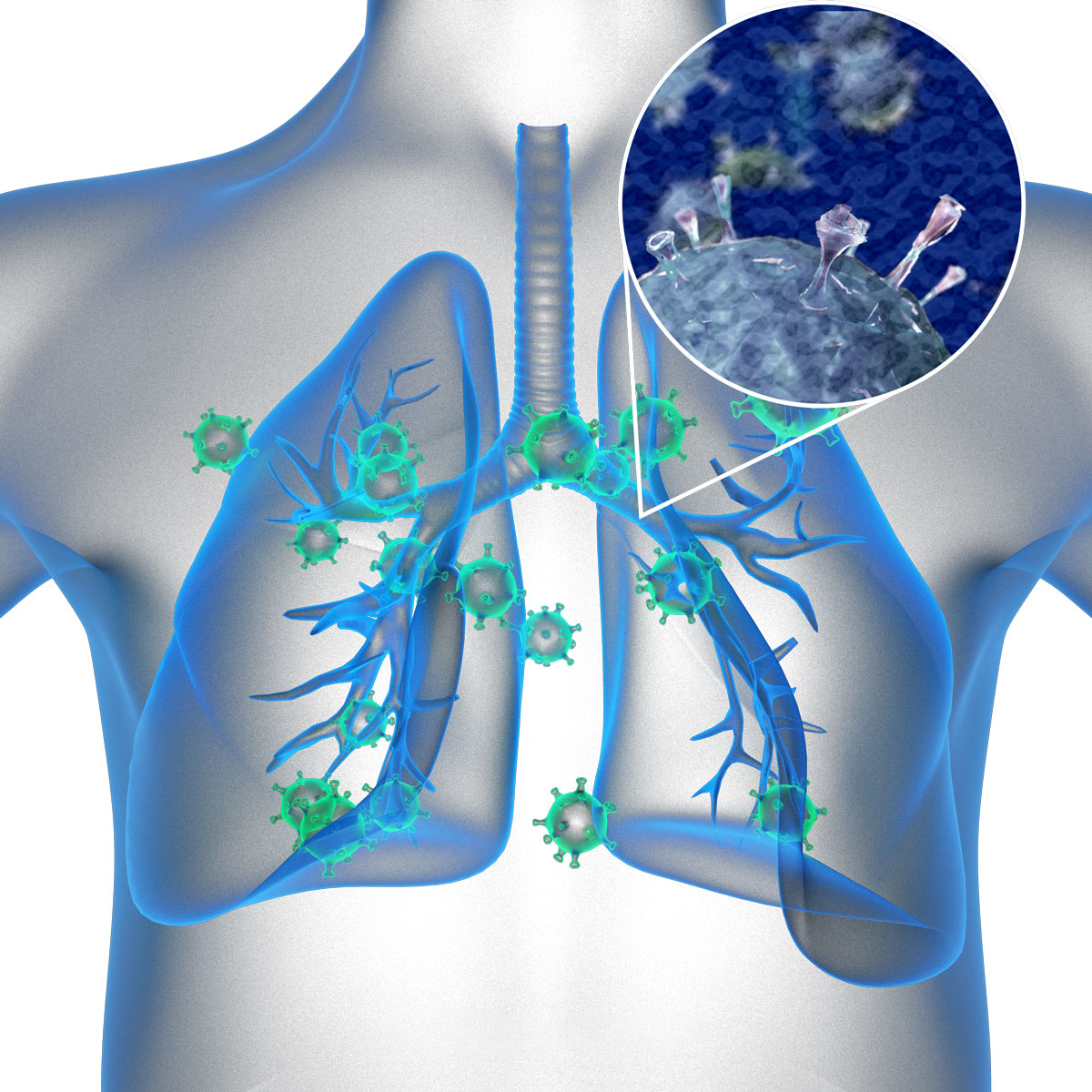 Virut RSV là nguyên nhân gây ra bệnh phổi hiện nay ở trẻ